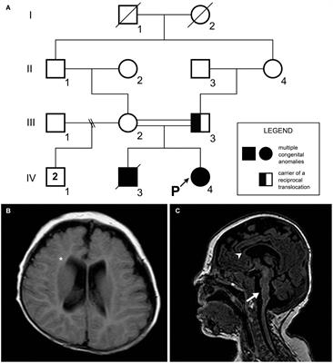 Candidate Genes Associated With Neurological Findings in a Patient With Trisomy 4p16.3 and Monosomy 5p15.2